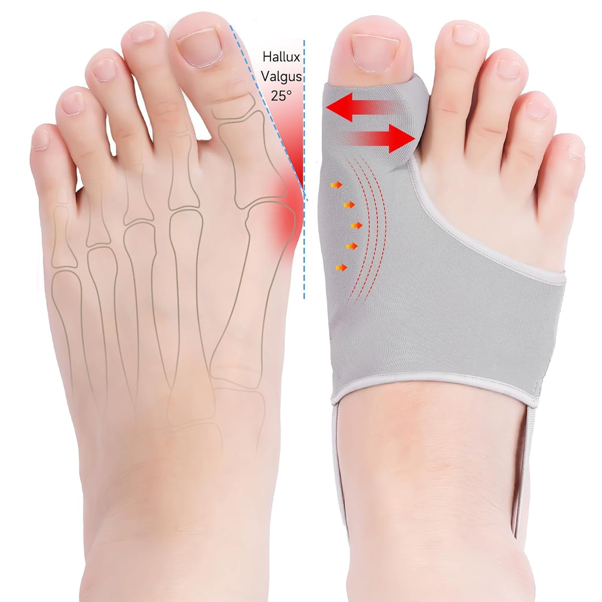 HYGGEAR Großzehen-Bunion-Korrektor (Hallux Valgus).